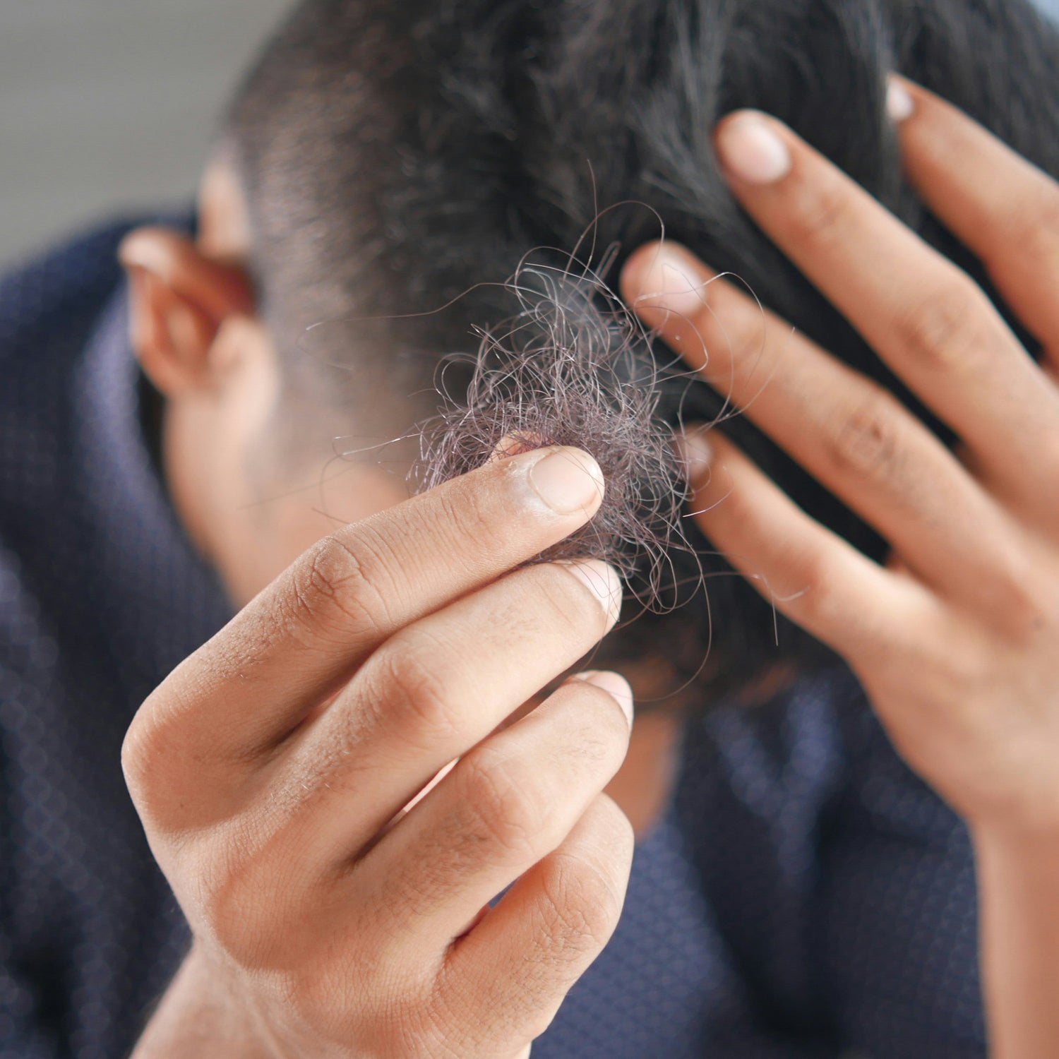Hairloss